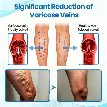 🇨🇦✅✅GFOUK® VascuCare Vein Healing Spray(Designed for Varicose veins, Spider veins, Deep vein Thrombosis, Chronic venous insufficiency, Venous ulcers, Thrombophlebitis and other venous issues)