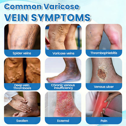 🇨🇦✅✅GFOUK® VascuCare Vein Healing Spray(Designed for Varicose veins, Spider veins, Deep vein Thrombosis, Chronic venous insufficiency, Venous ulcers, Thrombophlebitis and other venous issues)