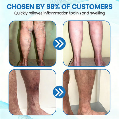 🇨🇦✅✅GFOUK® VascuCare Vein Healing Spray(Designed for Varicose veins, Spider veins, Deep vein Thrombosis, Chronic venous insufficiency, Venous ulcers, Thrombophlebitis and other venous issues)