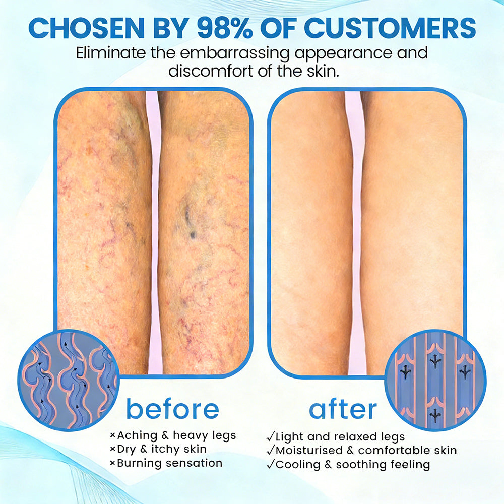 🇨🇦✅✅GFOUK® VascuCare Vein Healing Spray(Designed for Varicose veins, Spider veins, Deep vein Thrombosis, Chronic venous insufficiency, Venous ulcers, Thrombophlebitis and other venous issues)