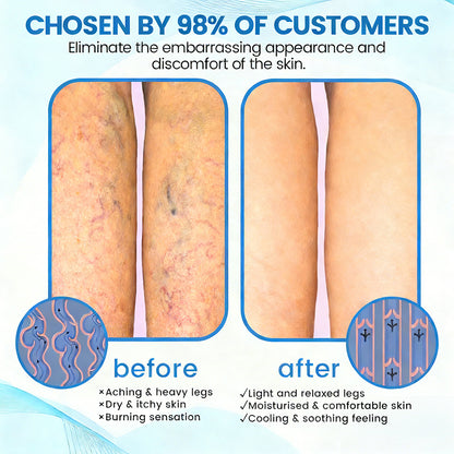 🇨🇦✅✅GFOUK® VascuCare Vein Healing Spray(Designed for Varicose veins, Spider veins, Deep vein Thrombosis, Chronic venous insufficiency, Venous ulcers, Thrombophlebitis and other venous issues)