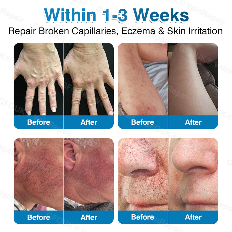 🇨🇦👨‍⚕️👨‍⚕️✅GFOUK® VeinRepair Microneedle Patch Roll⚡Instant Relief, Long-Term Results