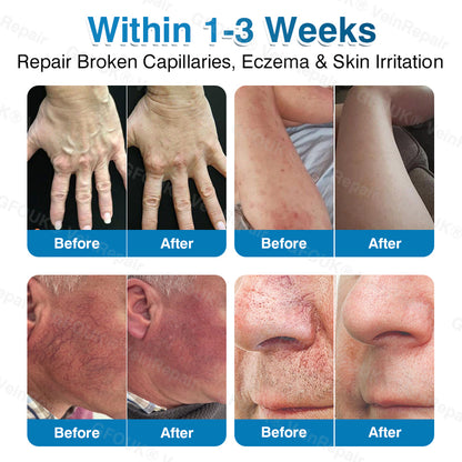 🇨🇦👨‍⚕️👨‍⚕️✅GFOUK® VeinRepair Microneedle Patch Roll⚡Instant Relief, Long-Term Results