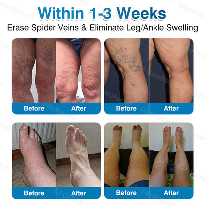 🇨🇦👨‍⚕️👨‍⚕️✅GFOUK® VeinRepair Microneedle Patch Roll⚡Instant Relief, Long-Term Results