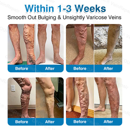 🇨🇦👨‍⚕️👨‍⚕️✅GFOUK® VeinRepair Microneedle Patch Roll⚡Instant Relief, Long-Term Results