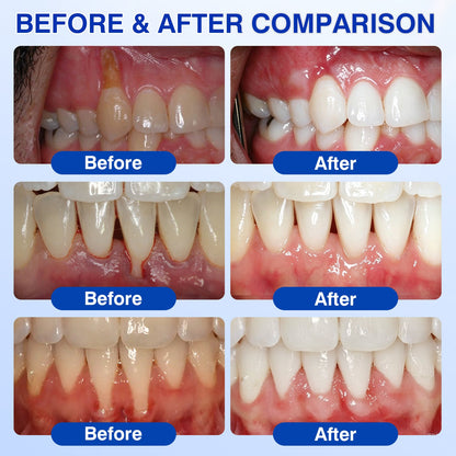 🇨🇦👨‍⚕️✅😁Evolvion® GumRevive Periodontal Repair Gel