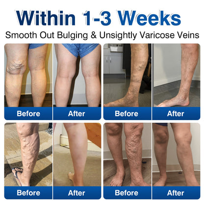 ca👨‍⚕️🦵🛡️GFOUK® VeinRenew Microneedle Balm