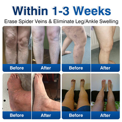 ca👨‍⚕️🦵🛡️GFOUK® VeinRenew Microneedle Balm