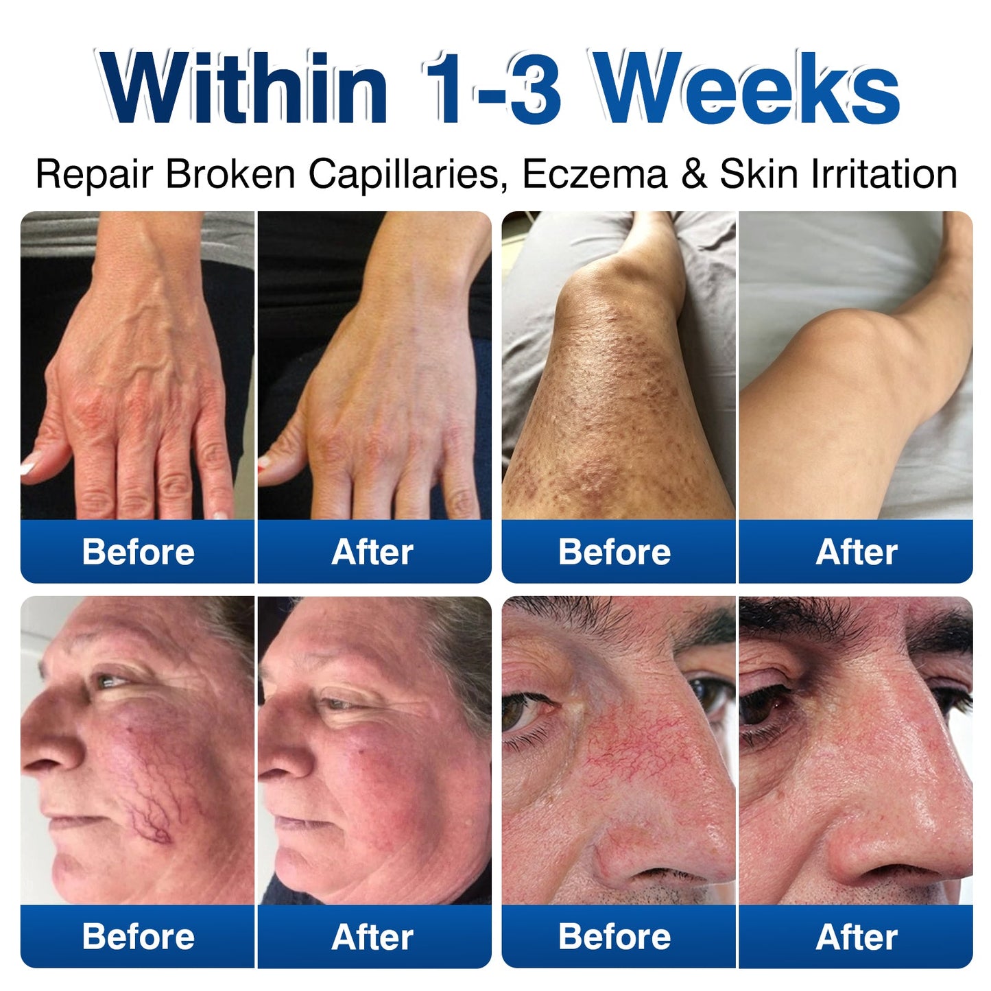 ca👨‍⚕️🦵🛡️GFOUK® VeinRenew Microneedle Balm