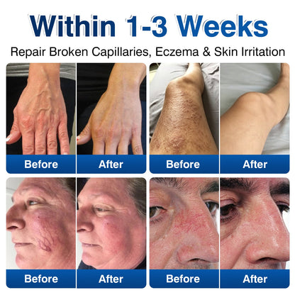 ca👨‍⚕️🦵🛡️GFOUK® VeinRenew Microneedle Balm