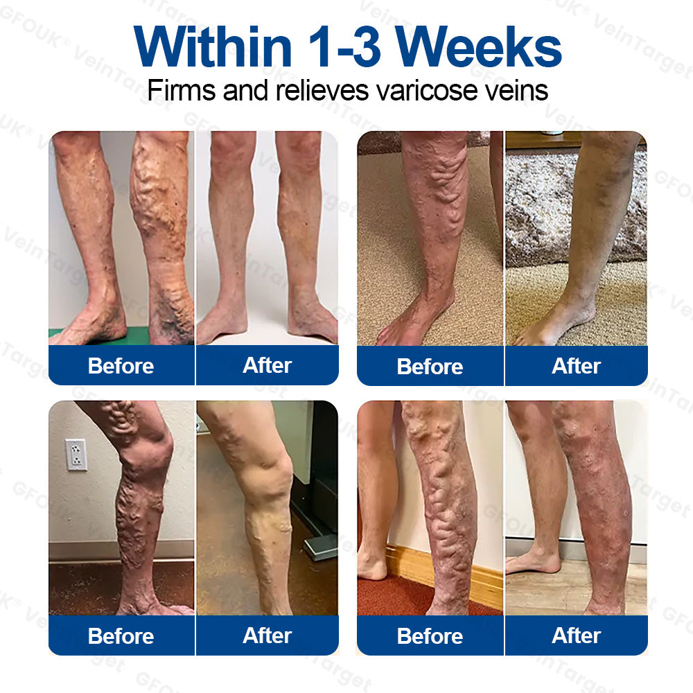 🇨🇦💙👨‍⚕️✅GFOUK® VeinTarget Microneedle Patch⚡Instant Relief, Long-Term Results