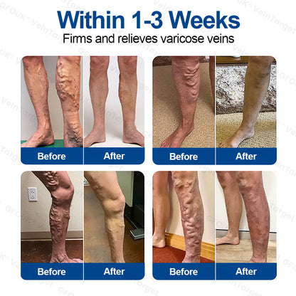 🇨🇦💙👨‍⚕️✅GFOUK® VeinTarget Microneedle Patch⚡Instant Relief, Long-Term Results